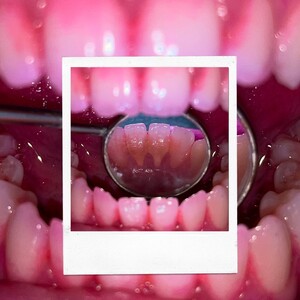 Image of Teeth cleaning