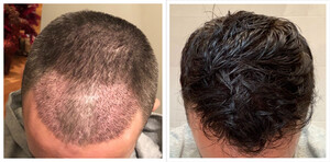 Image of Hair transplant - Rubenhair