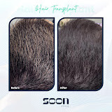 Image of Hair transplant