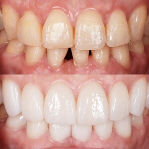 Image of Before and after dental treatment