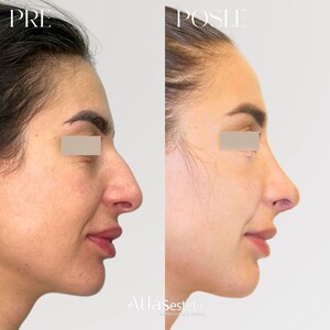 Image of Rhinoplasty