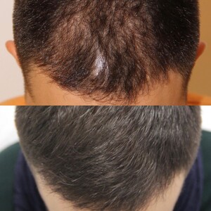 Image of Hair transplant