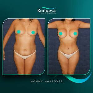 Image of Mommy Makeover