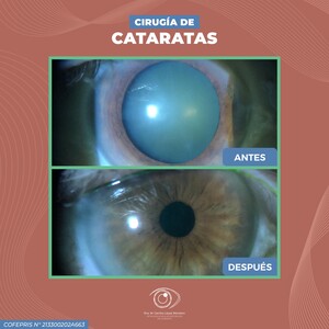 Image of Cataract surgery before and after