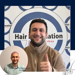 Image of Hair transplant before and after