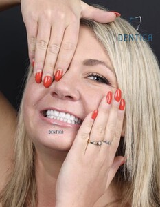 Image of After Hollywood smile