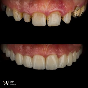 Image of Zirconia crowns