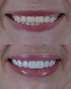 Image of Smile makeover before and after