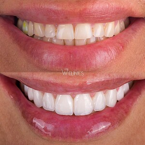 Image of Hollywood smile