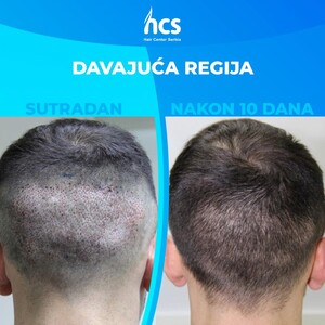 Image of FUE hair transplant