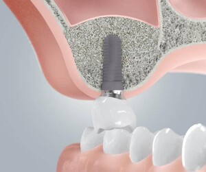 Image of Dental implants