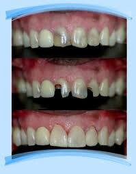 Image of Before and after dental treatment