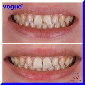 Image of Laminate veneers