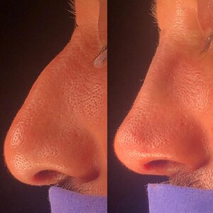 Image of Male Rhinoplasty - Dr Asef Ulutürk