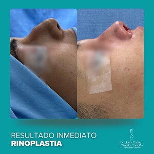 Image of Rhinoplasty