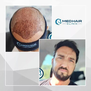 Image of Medhair Clinic Hair Transplant Gallery 0