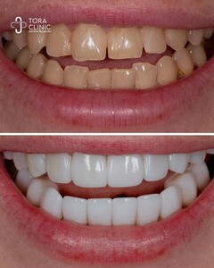 Image of Hollywood smile