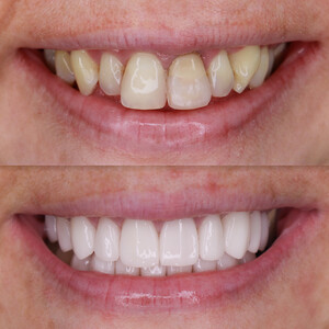 Image of Teeth Whitening - Delta Clinic Dent