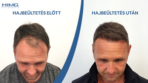 Image of Hair transplantation