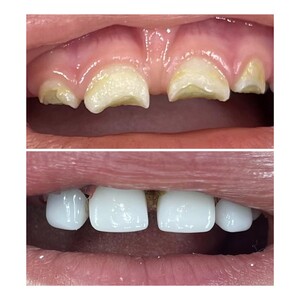 Image of Zirconia crowns - Crystal Dental Clinic 