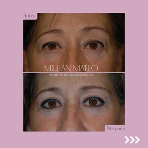 Image of Eyelid surgery - Millan Mateo Institute