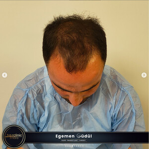 Image of Egemen Güdül Hair Clinic Ankara Gallery 0