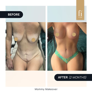 Image of Mommy Makeover - Fi Clinica