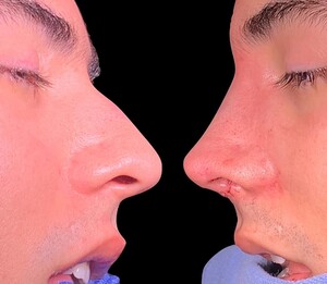 Image of Rhinoplasty