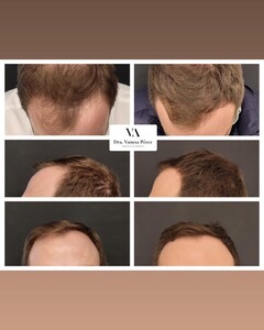 Image of FUE Hair transplant