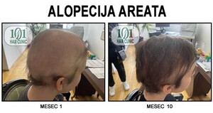 Image of Hair loss treatment