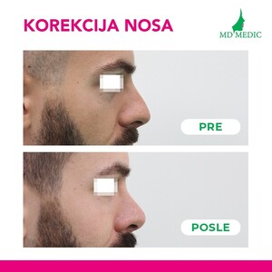 Image of Nose Correction - MD Medic