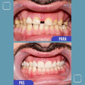 Image of Dental implants