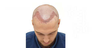 Image of More and More Hair Transplant Gallery 1