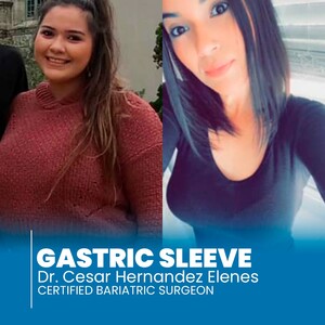 Image of Before and after gastric sleeve surgery