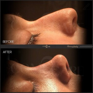 Image of Rhinoplasty