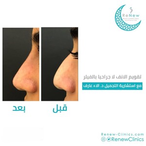 Image of Renew Clinics excels in rhinoplasty procedures. 