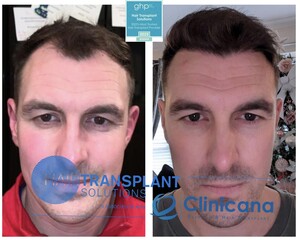 Image of Hair Transplant Solutions Gallery 0