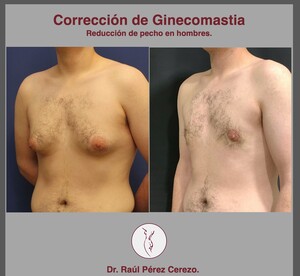 Image of Gynecomastia