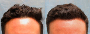 Image of PRP for Hair Loss - Rubenhair