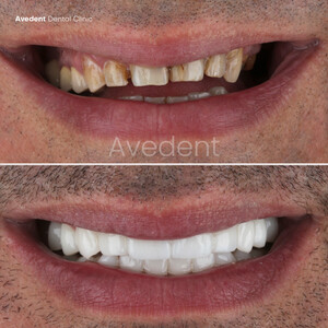 Image of Avedent Dental Clinic Turkey Gallery 1