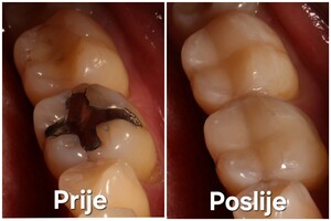 Image of Fillings - IDC Ruzevic