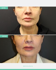 Image of Face operation - Faccia 