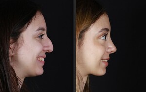 Image of Rhinoplasty