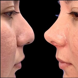 Image of Before and after rhinoplasty