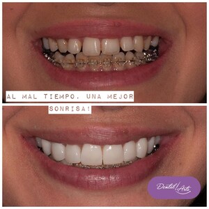 Image of Braces