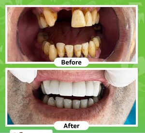 Image of Dental implants