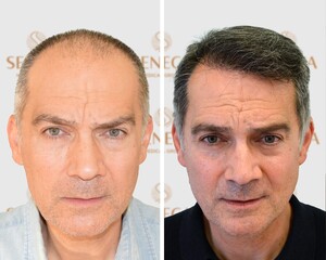 Image of Seneca Hair Transplant Gallery 0