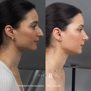 Image of VIP-Rhinoplasty Center - Dr. Moireas Georgios Gallery 2