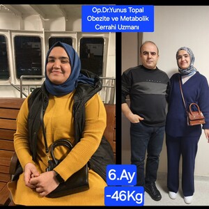 Image of Obesity surgery 6th month