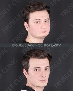 Image of Double Jaw and Genioplasty